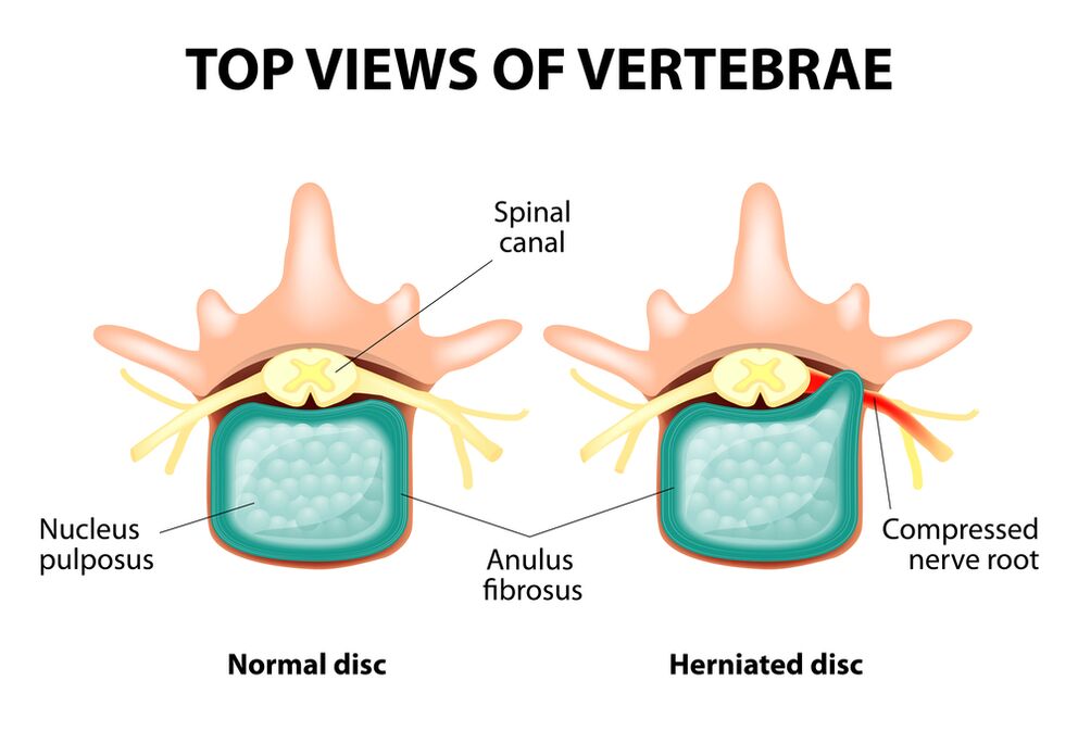Sağlıklı intervertebral disk ve fıtık