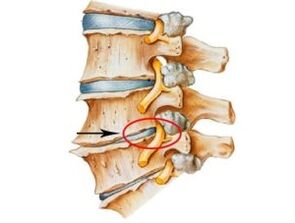 Osteokondrozun belirtileri ve semptomları