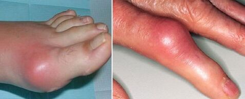 artritli eklemlerin görünümü