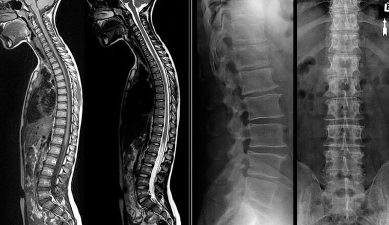 Osteokondroz için röntgen ve MRI resimleri