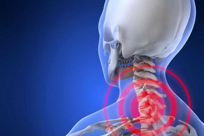 Boyunda ağrı çekmek - servikal osteokondrozun erken bir belirtisi