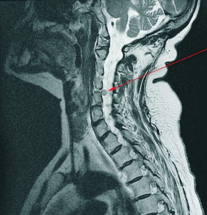 MRI'da servikal omurganın intervertebral fıtığı