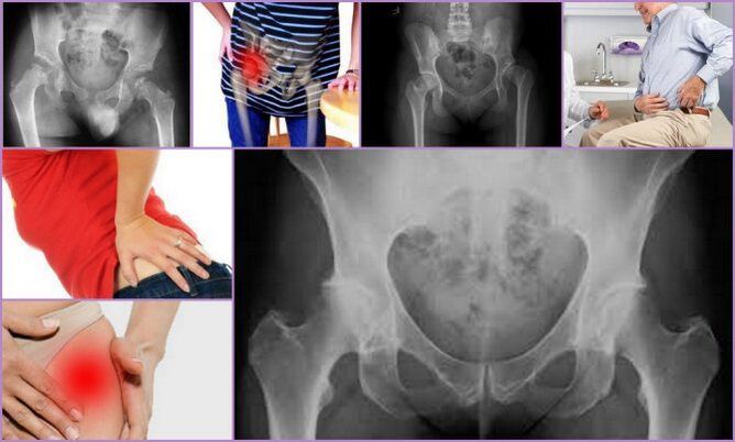 Ağrı ve sınırlı hareketlilik, kalça osteoartritinin ana semptomlarıdır. 