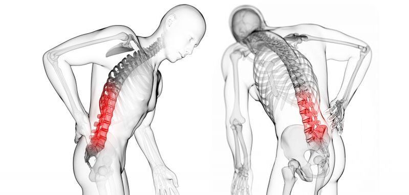 Servikal osteokondroz ile ilgili komplikasyonlar